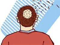 为什么人会秃顶？